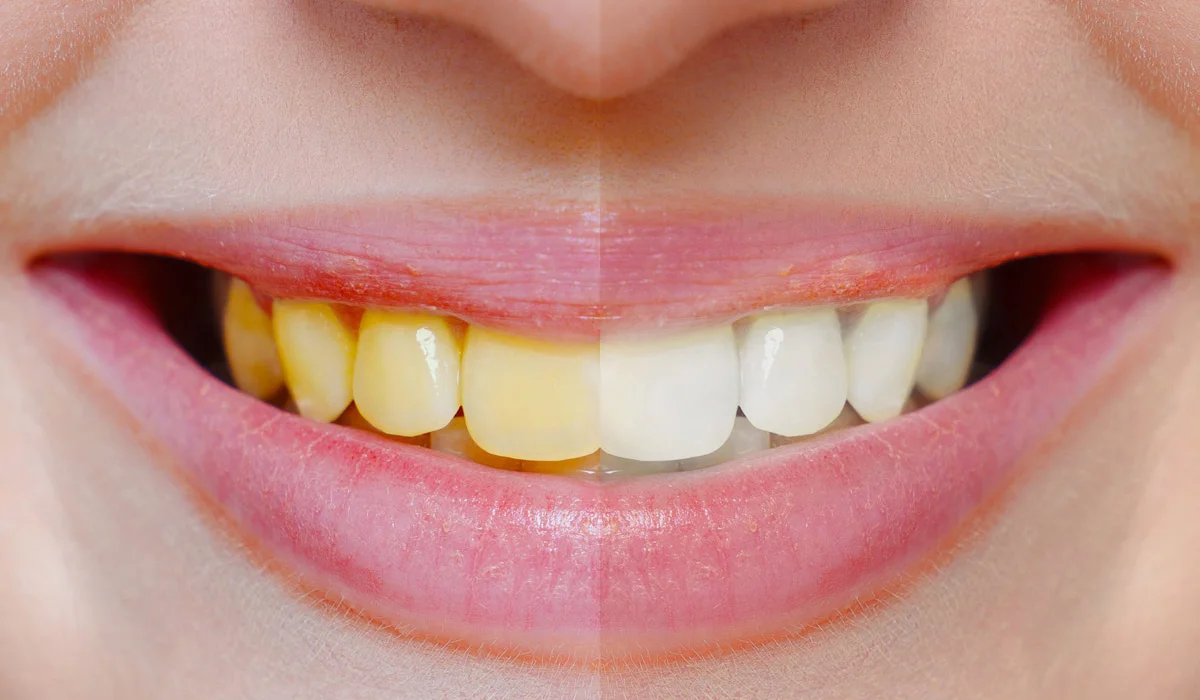 How to Whiten Teeth in Snapseed